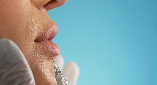 en una de las clínicas de relleno de labios, una paciente se realiza este procedimiento