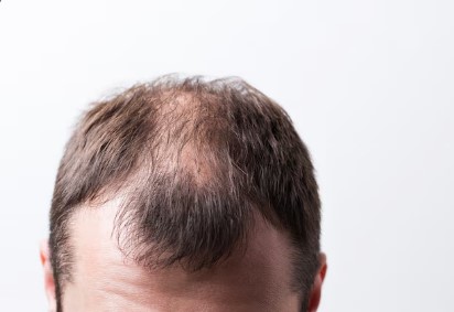Paciente para implante de pelo sin rasurar