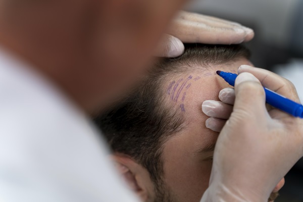 Injerto de cabello - Tricólogo realizando el diseño del trasplante capilar a un hombre con alopecia en las entradas