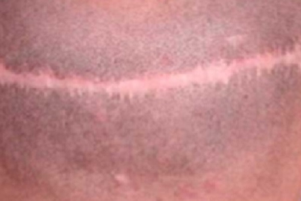 Injerto de cabello - Muestra del método FUT en trasplante capilar