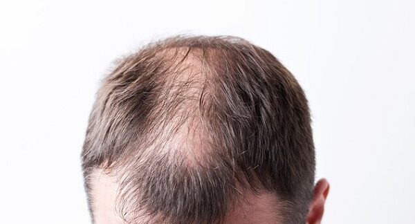 Injerto de cabello - Hombre con alopecia androgénica antes de realizarse un injerto de cabello CDMX